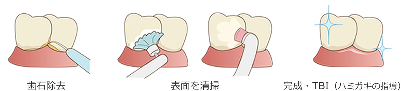 歯のクリーニング・PMTCの流れ
